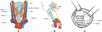 Echotexture of recurrent laryngeal nerves: the depiction of recurrent laryngeal nerves at high-frequency ultrasound during radical thyroidectomy